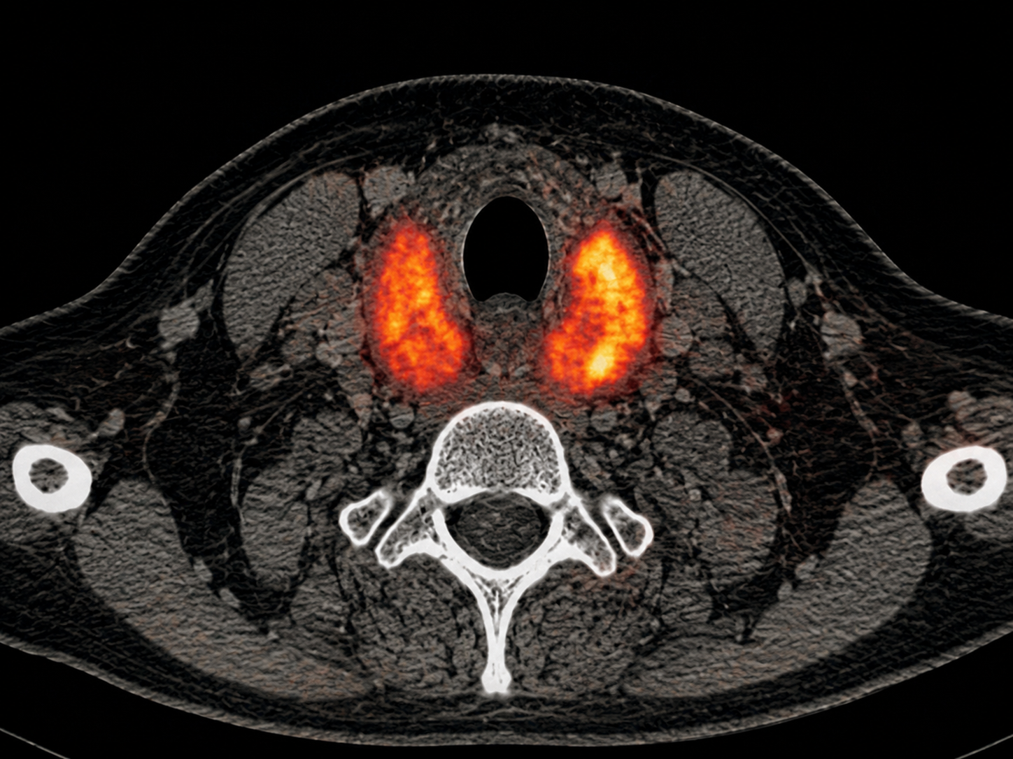A United Theranostics patient receiving a SPECT/CT as a part of their  radiopharmaceutical therapy.